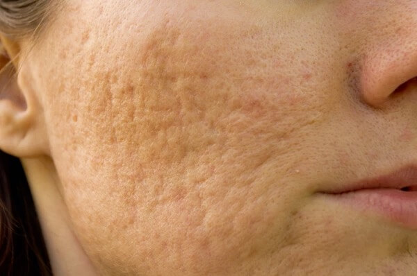 Causes of acne and post-acne