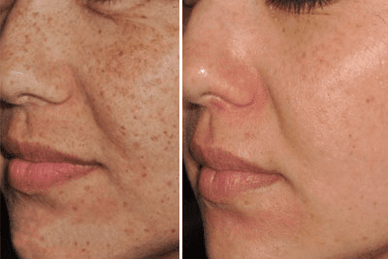 IPL for pigmentation