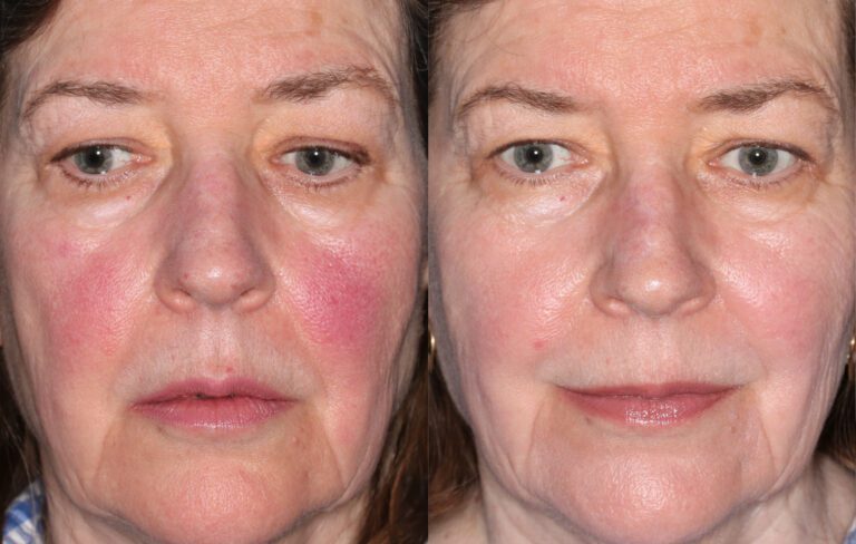 IPL for rosacea