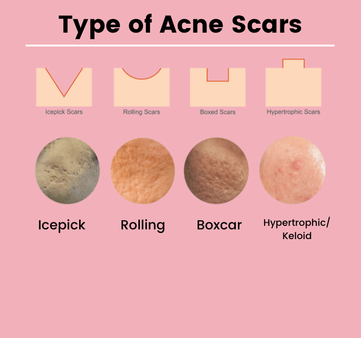 Types-of-Acne-Scars