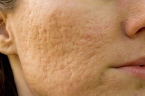 acne scar types Los Angeles