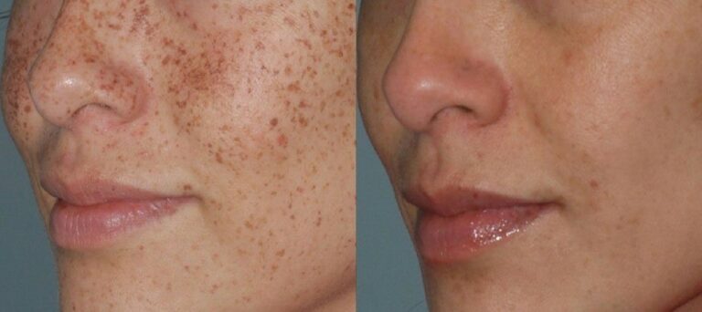 brown spot removal with Lumecca IPL treatment before-after