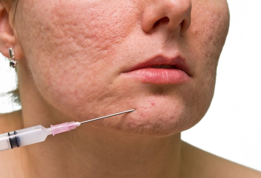 dermal fillers for acne scars Los Angeles