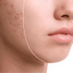 how to get rid of acne scars