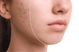 how to get rid of acne scars