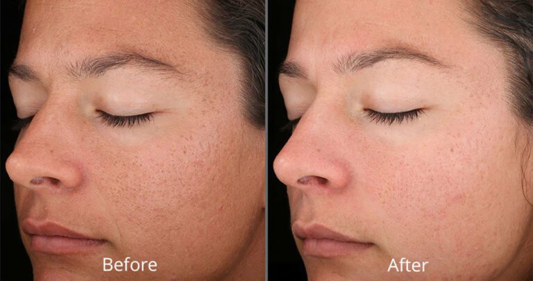 skin peel for pores Los Angeles