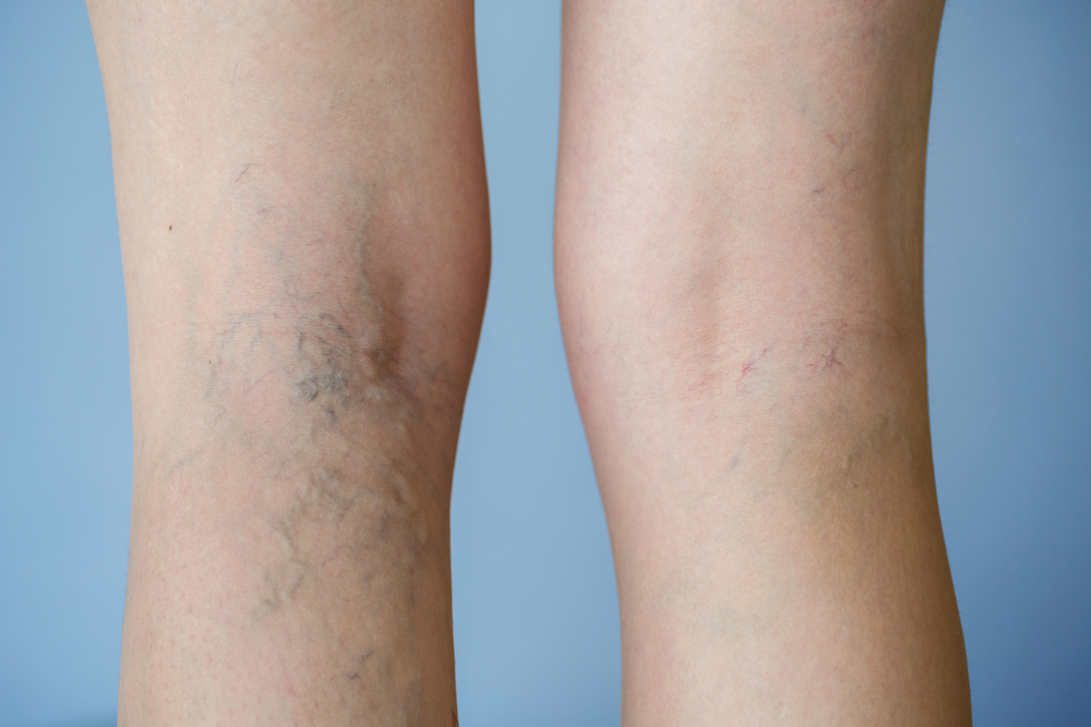 vein treatment via IPL