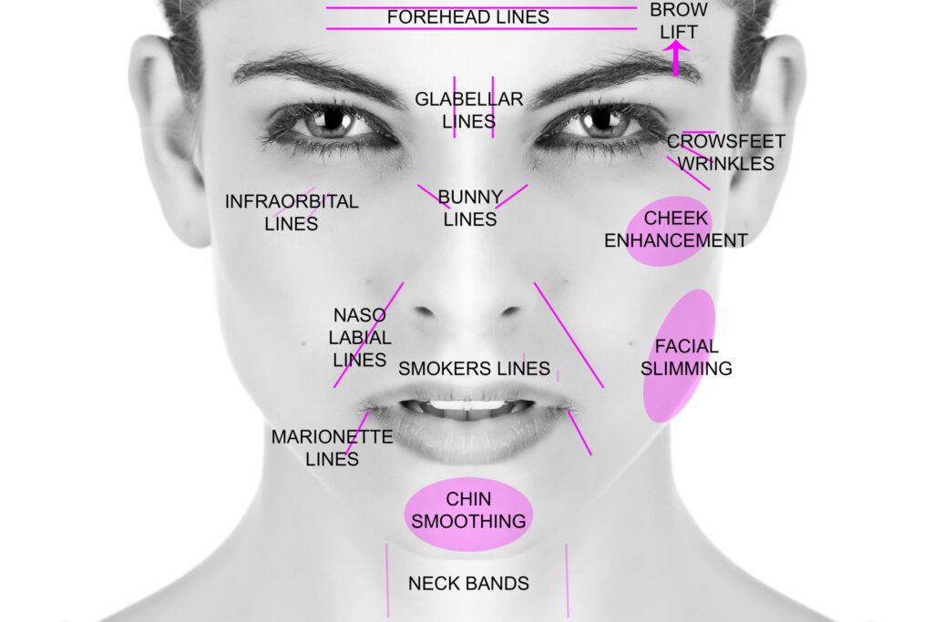 Botox for facial lines treatment Los Angeles