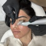 Microneedling treatment Los Angeles