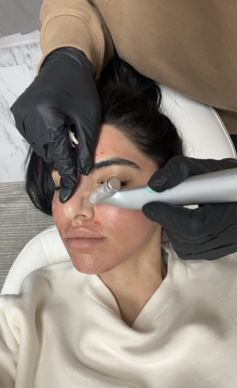 Microneedling treatment or Vampire facial Los Angeles