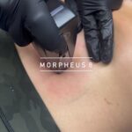 Morpheus8 Los Angeles abdomen treatment
