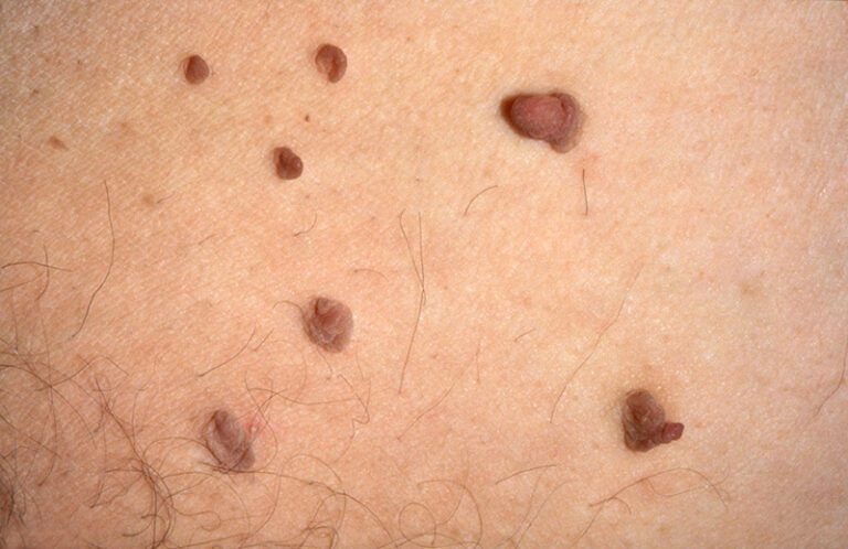 Skin Tag Removal Los Angeles