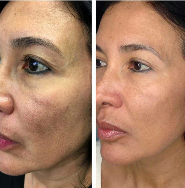 Vampire Facelift Before-And-After Los Angeles