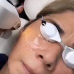 best Lumecca IPL photofacial in Los Angeles