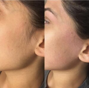 Facial laser hair removal before-after Los Angeles