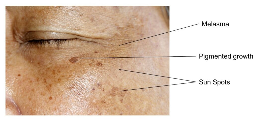 skin pigmentation diagram Los Angeles