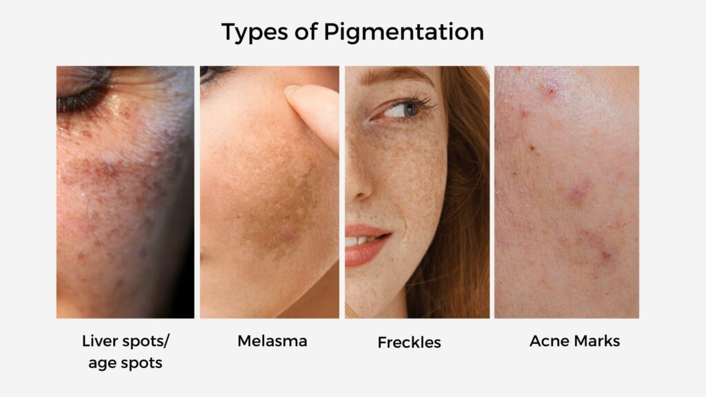 skin pigmentation types