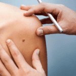 skin tags removal procedure Los Angeles