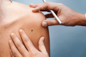 skin tags removal procedure Los Angeles