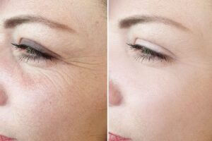 Chemical Peel for anti-aging Los Angeles