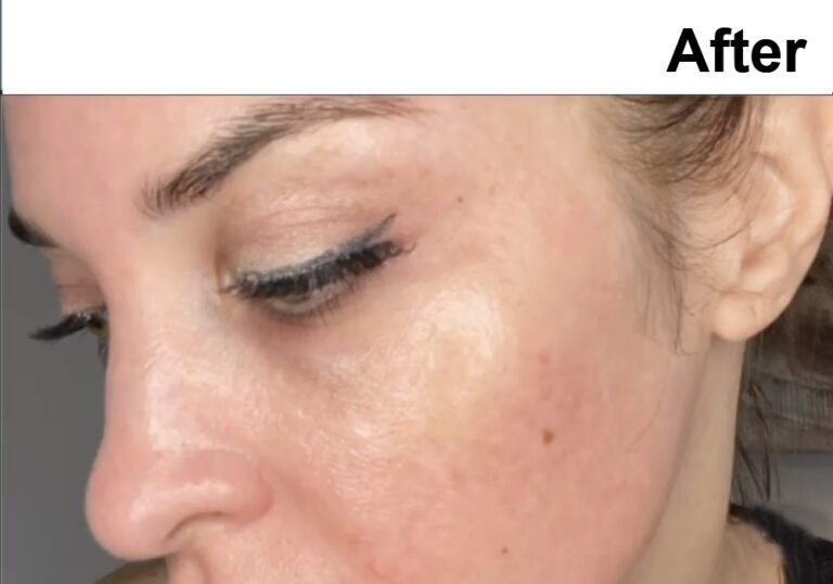 Chemical-peel-treatment-before-after-Los-Angeles