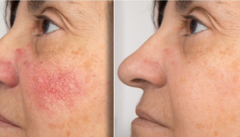 Lumecca IPL veins vascular therapy before-after Los Angeles
