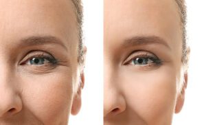 Microneedling anti-aging therapy Los Angeles
