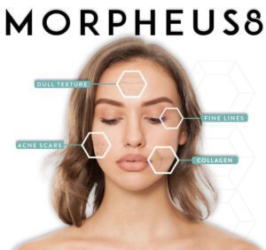 Morpheus 8 Los Angeles