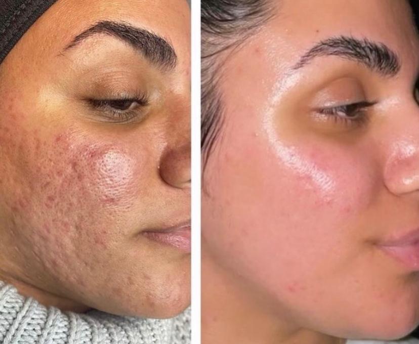 Morpheus8 microneedling Los Angeles