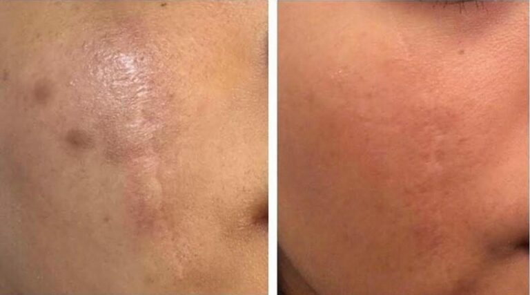Morpheus8 scars treatment before-after Los Angeles