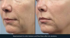 Morpheus8 anti-aging treatment Los Angeles