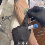 PRP Facelift