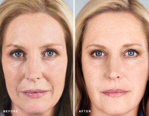 Sculptra anti-aging before-after Los Angeles