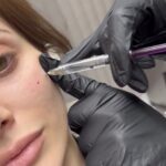 filler injections Los Angeles