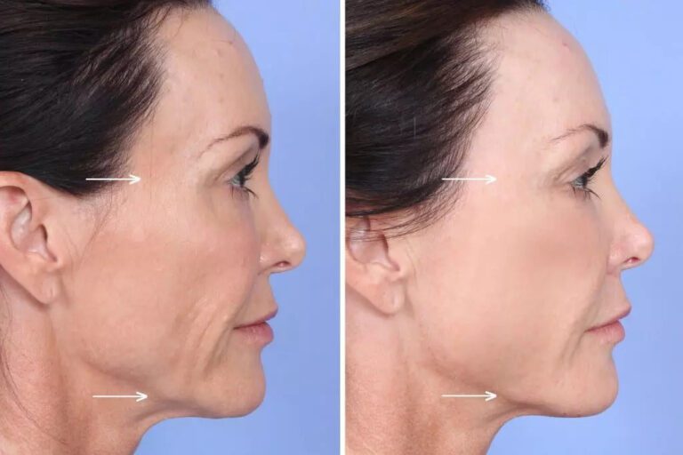 Sculptra filler injection in cheek before after Los Angeles