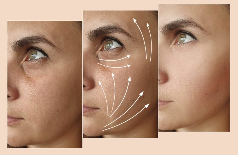 Sculptra injections for facial volume and contouring Los Angeles