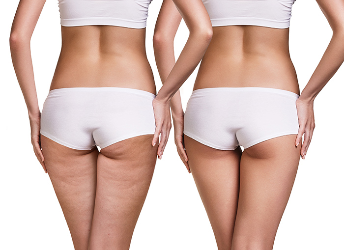The New FDA-Approved Injection Can Cure Cellulite