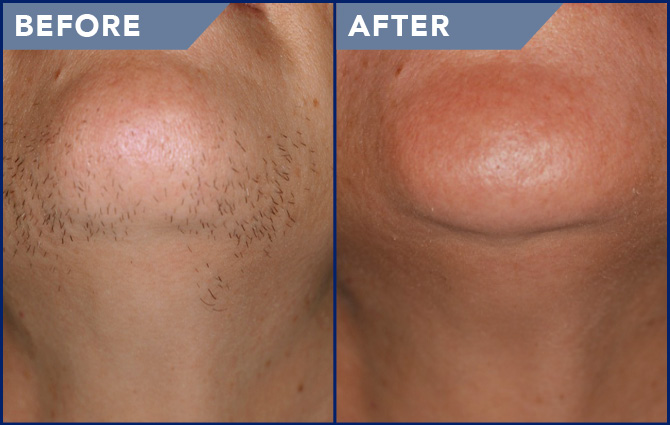 before-after Laser hair removal treatmentLos Angeles