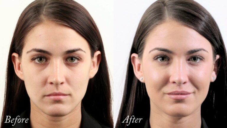 dermal fillers before after