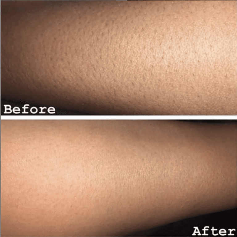 laser hair removal before-after Los Angeles