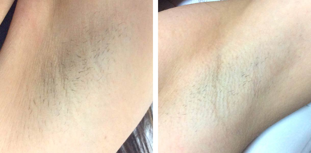 laser hair removal treatment after one procedure Los Angeles