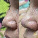 nose lifting via PDO threads Los Angeles