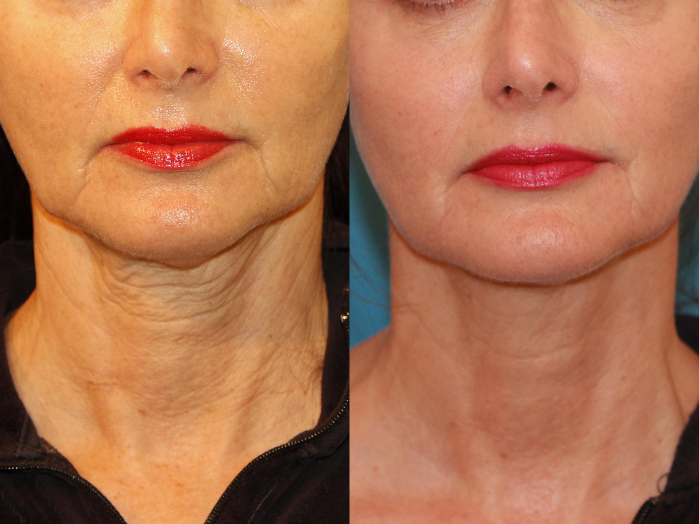 sculptra before-after neck procedure Los Angeles