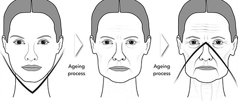 Is-thread-lift-good-for-facial-ptosis