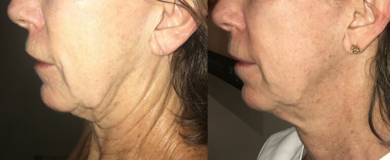 Lift And Tighten Loose Skin with Morpheus8 before-after Los Angeles