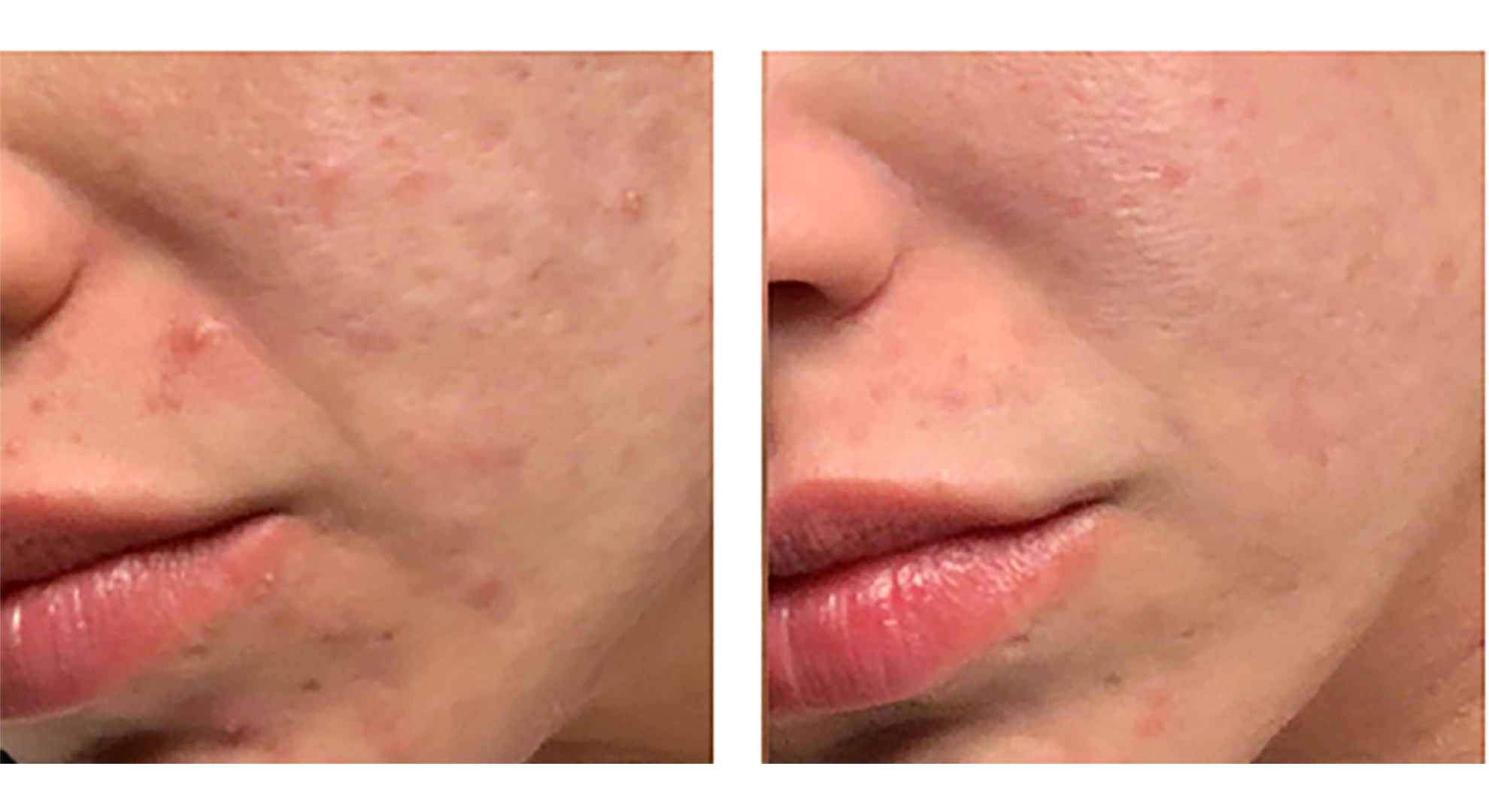 Minimize acne scarring with Morpheus8 Los Angeles