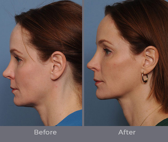 Morpheus8 rejuvenation before-after Los Angeles