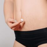 Morpheus8 treatment for stretch mark in belly