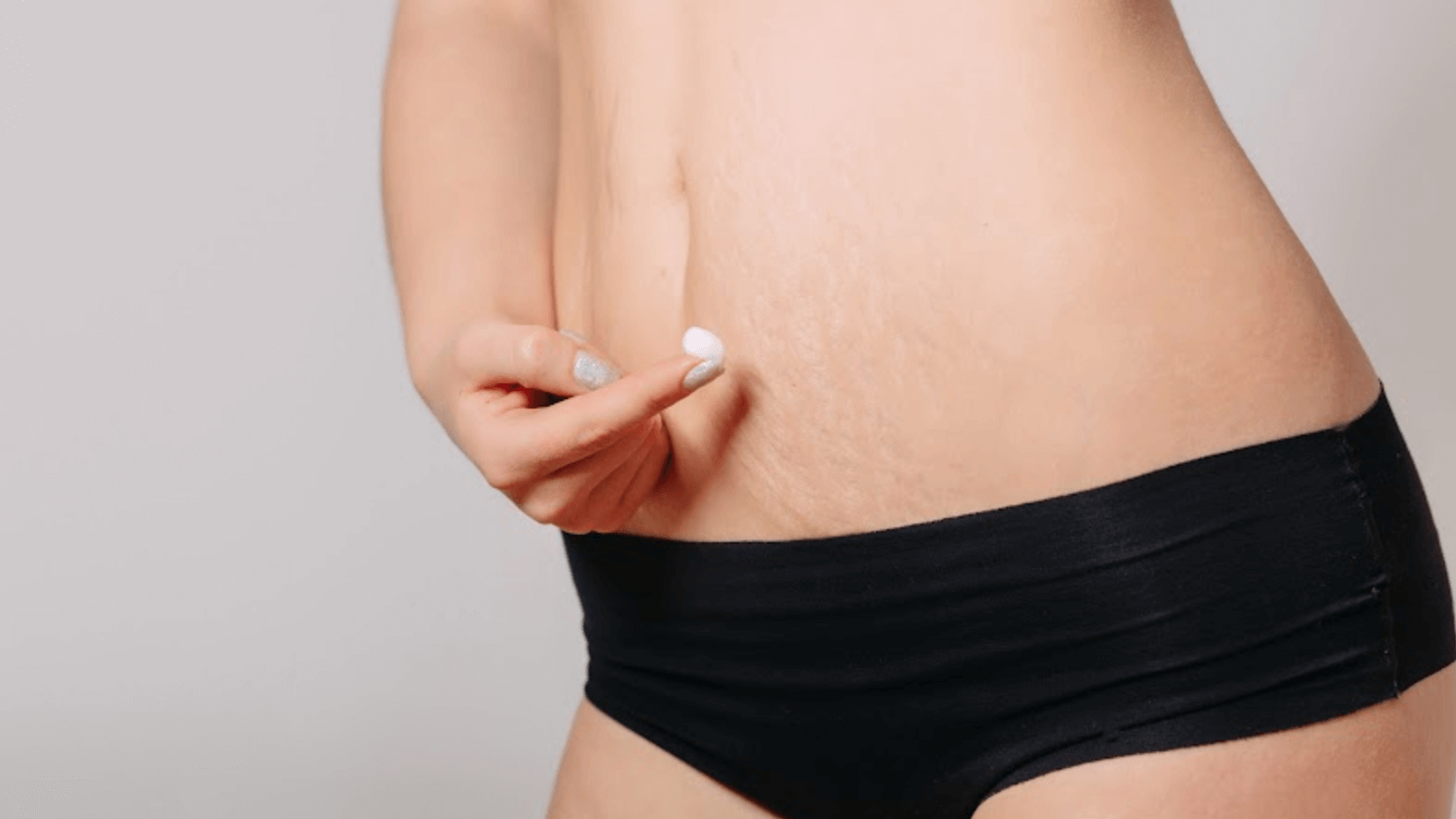 Morpheus8 treatment for stretch mark in belly
