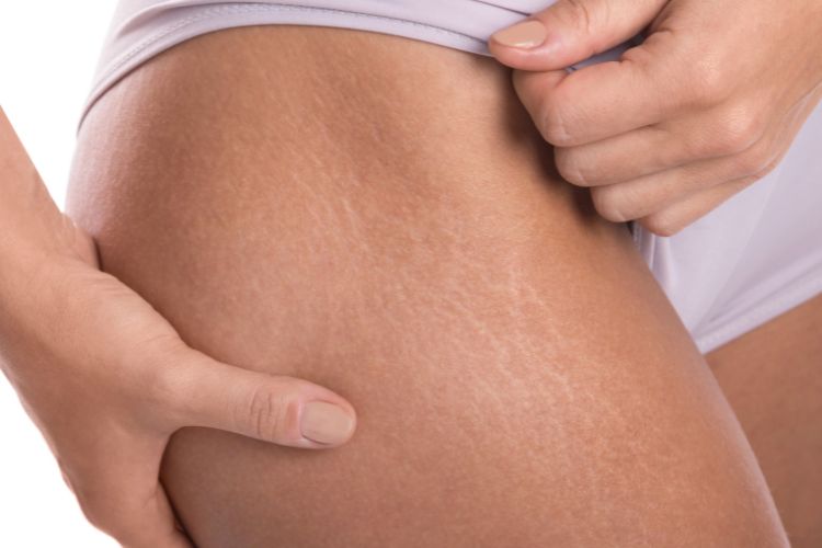 Morpheus8 treatment for stretch marks Los Angeles